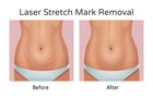 Regain Confidence with Stretch Mark Removal in Melbourne: Your 